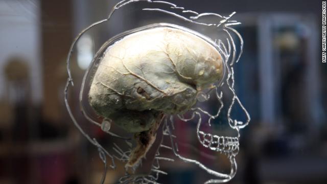 A real human brain being displayed as part of new exhibition at the @Bristol attraction is seen on March 8, 2011 in Bristol, England. The Real Brain exhibit - which comes with full consent from a anonymous donor and needed full consent from the Human Tissue Authority - is suspended in large tank engraved with a full scale skeleton on one side and a diagram of the central nervous system on the other and is a key feature of the All About Us exhibition opening this week.