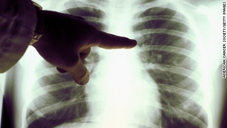 Mais pessoas estão sofrendo de câncer de pulmão nos EUA, de acordo com o relatório (2019)