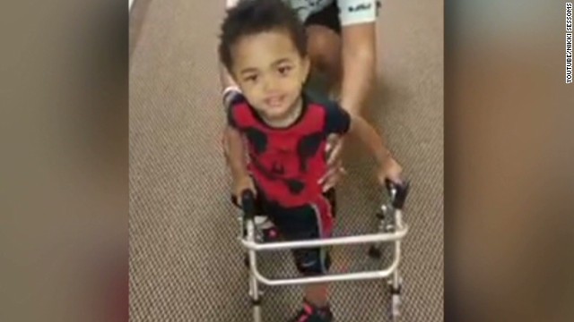 hln toddler amputee walks prosthetic leg mike vick_00003209.jpg