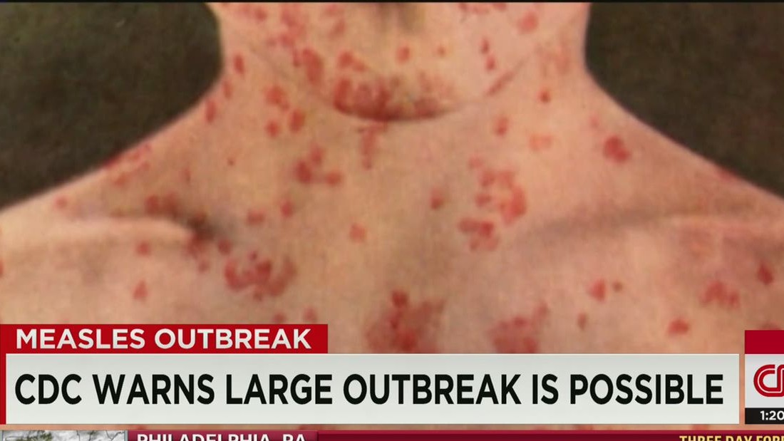 Measles Case Reported In Another State Cnn 3132