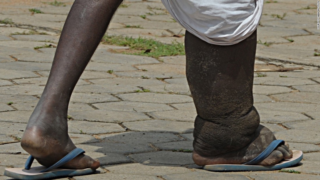 Every Last Worm Eliminating Elephantiasis In India CNN