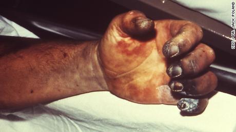 From plague to polio ... 10 diseases that you thought (wrongly) disappeared