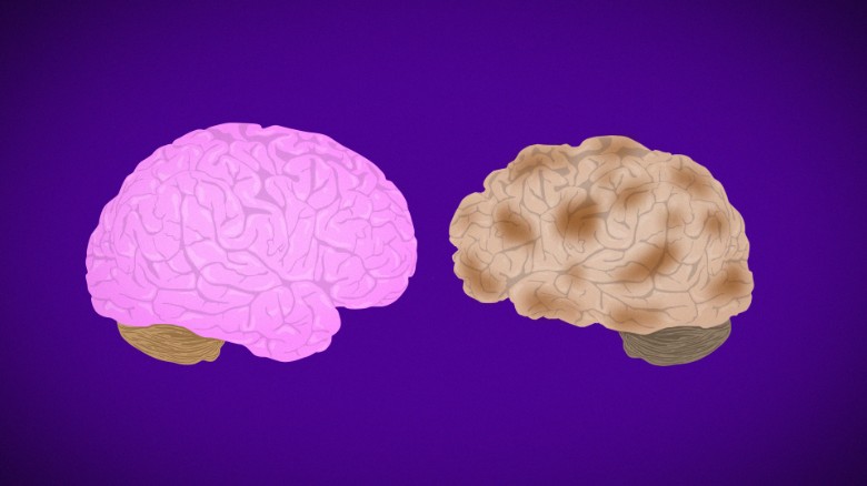 How Alzheimer's destroys the brain