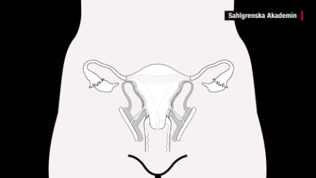 uterus transplants explained cohen mss orig_00010103.jpg