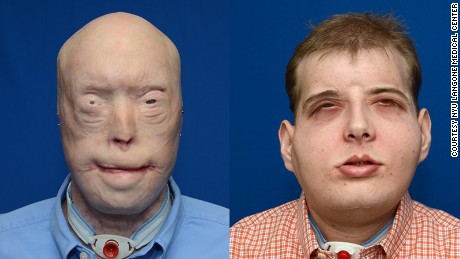 The & # 39; Extreme & # 39; face transplant in history gives new life to the fire