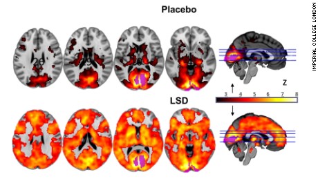 This is your brain on LSD, literally