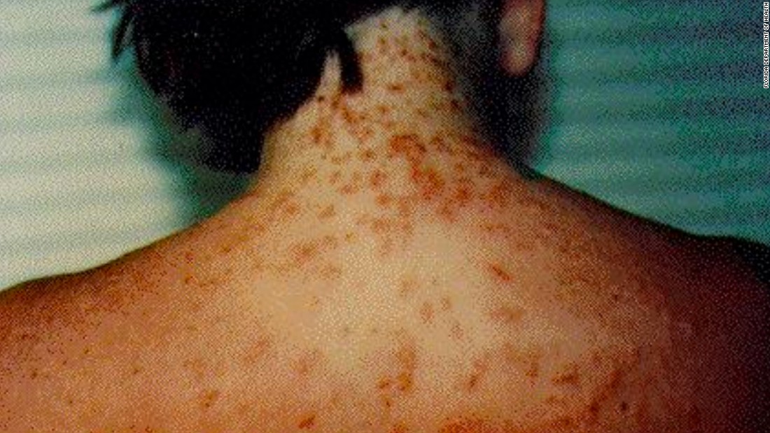 severe swimmers itch