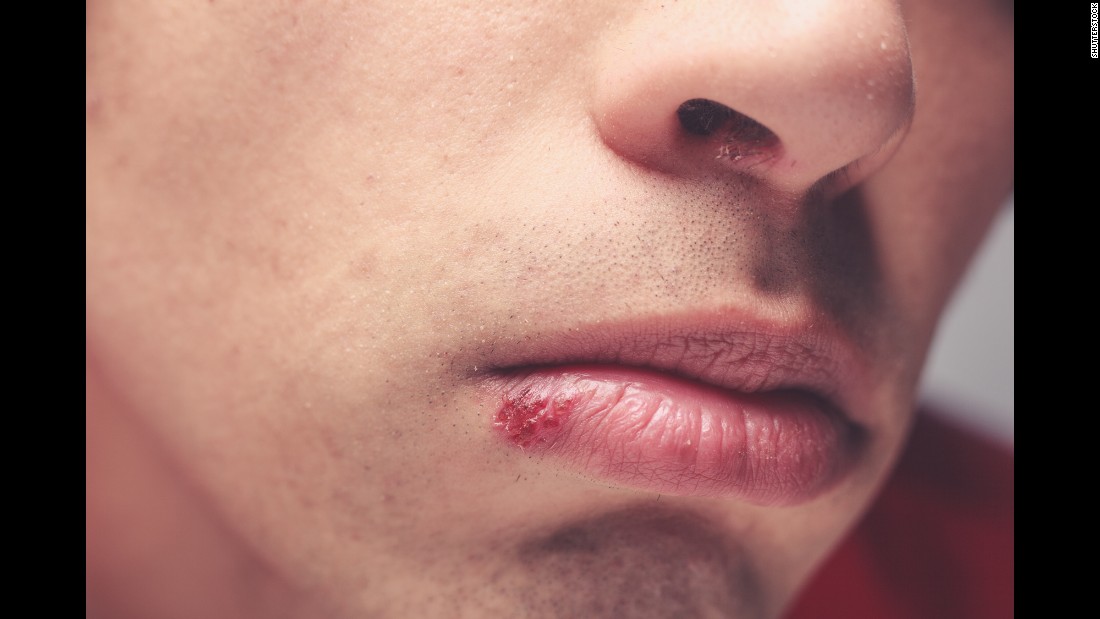 Five Diseases You Can Get From Kissing 