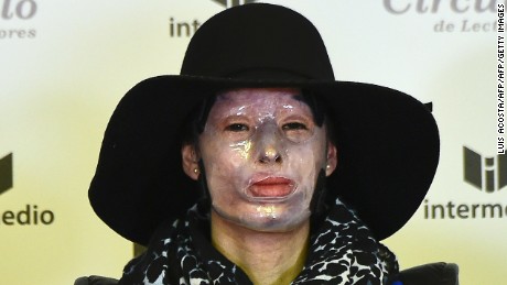 Colombian victim of assault using acid Natalia Ponce De Leon gives a press conference during the launching of her book " Rebirth of Natalia Ponce de Leon" in Bogota on 16 April 2015.  Natalia was burnt with acid on March 27, 2014. In Colombia such aggressions are categorized as equivalent to hitting and the maximum penalty for them is four years in prison. Victims of this kind of aggression are organizing to claim for more severe punishments.  AFP PHOTO/Luis Acosta        (Photo credit should read LUIS ACOSTA/AFP/Getty Images)