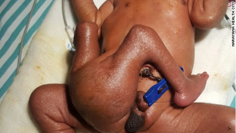 Indian Boy Born With Legs Penises Recovering After Surgery Cnn