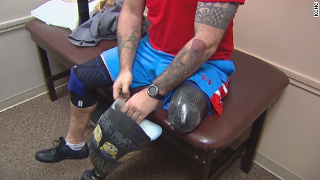 Combat veteran amputee gets permanent prosthesis.
