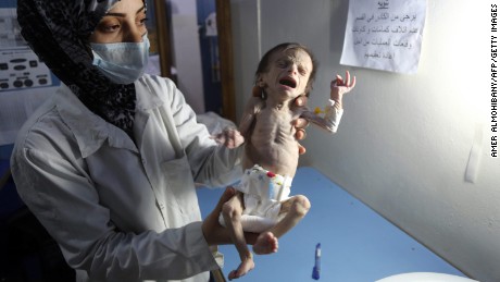 An infant suffering from severe malnutrition in Eastern Ghouta.