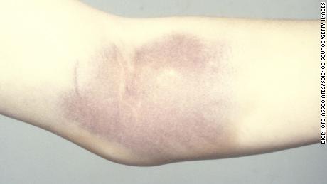 Internal blood clotting in a hemophiliac