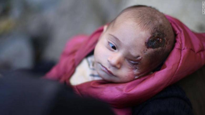 Children in Syria's Eastern Ghouta suffering