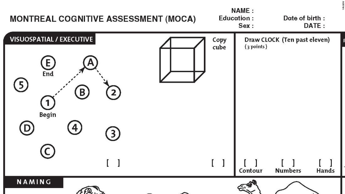 Assessment of general cognitive MMSE Moca tics