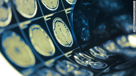 Covid-19 neurological symptoms emerge in most hospitalized patients, study says