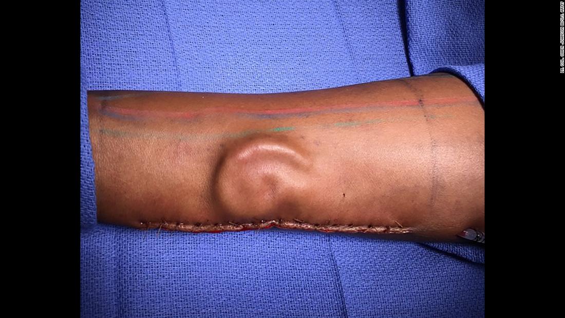 This photo, released on Monday, May 7, shows how doctors &lt;a href=&quot;https://www.cnn.com/2018/05/10/health/ear-forearm-surgery-trnd/index.html&quot; target=&quot;_blank&quot;&gt;grew a US soldier&#39;s new ear in her forearm.&lt;/a&gt; Pvt. Shamika Burrage lost her left ear in a car accident two years ago, but plastic surgeons were able to harvest cartilage from her ribs to create a new one. It grew in her arm and then was successfully attached to her head.