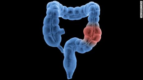 Colon cancer misdiagnosis in younger adults is a concern, study suggests