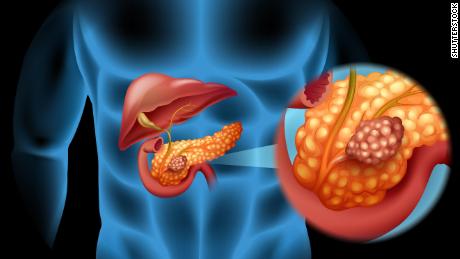 Study finds diabetes after 50 years could be an early sign of pancreatic cancer