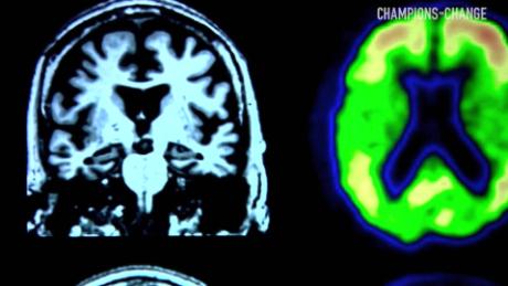 Is Alzheimer&#39;s disease preventable? 