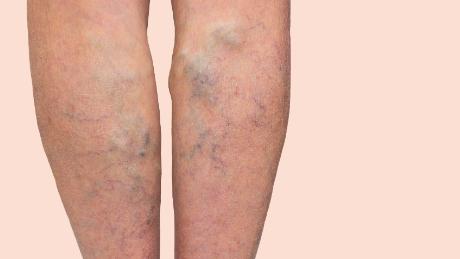 Varicose veins in the legs of a woman.