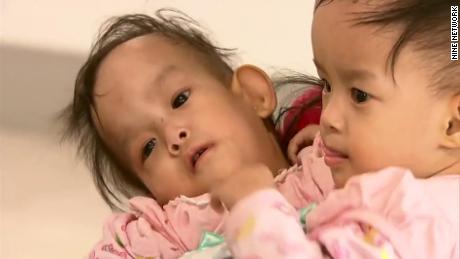 Conjoined Bhutanese twins separated after six-hour surgery.