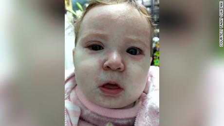 This baby has caught measles because of anti-vaxers