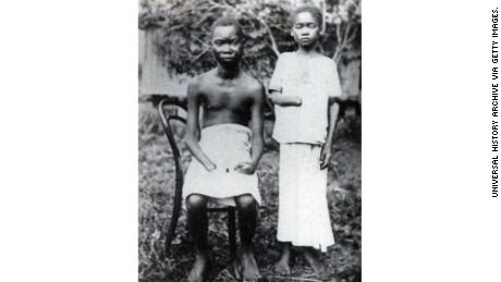 Amputation wurde häufig verwendet, um Arbeiter und ihre Familien im Freistaat Kongo zu bestrafen, der von König Leopold II. Von Belgien kontrolliert wurde.
