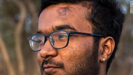 Bhanu's head injury left him with a scar, but he was determined not to let it define him.