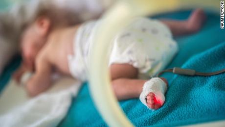 Preemies may have greater risk of premature death as adults, estudio sugiere