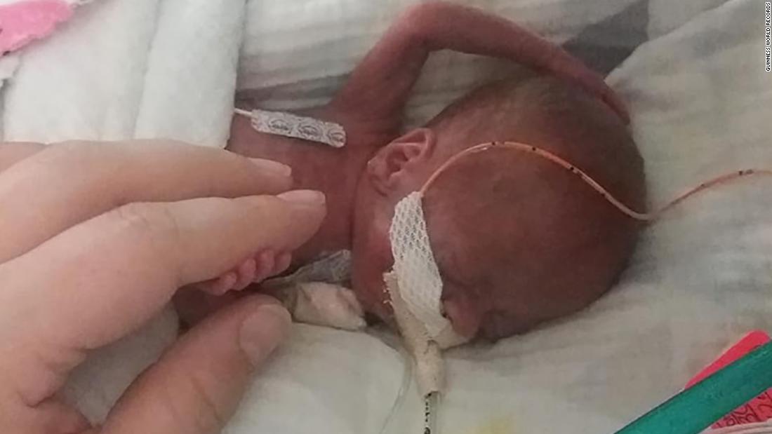 The World S Most Premature Baby Has Celebrated His First Birthday After