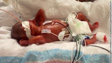 Curtis weighed just 14.8 ounces on the day of his birth and immediately was put on a ventilator.