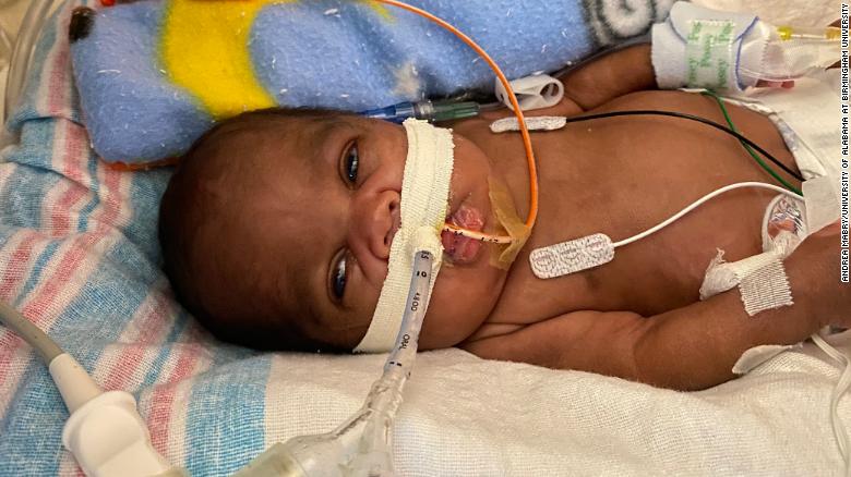 An Alabama baby was born less than a pound and at 21 semanas. Now he holds a world record