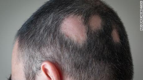 Alopecia areata begins with one or more small bald patches, typically on a person&#39;s scalp. 
