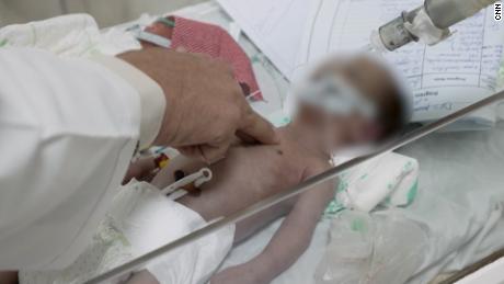A malnourished child under a doctor&#39;s care in Afghanistan.