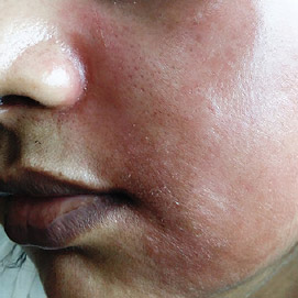 Closeup of patient with Erythema