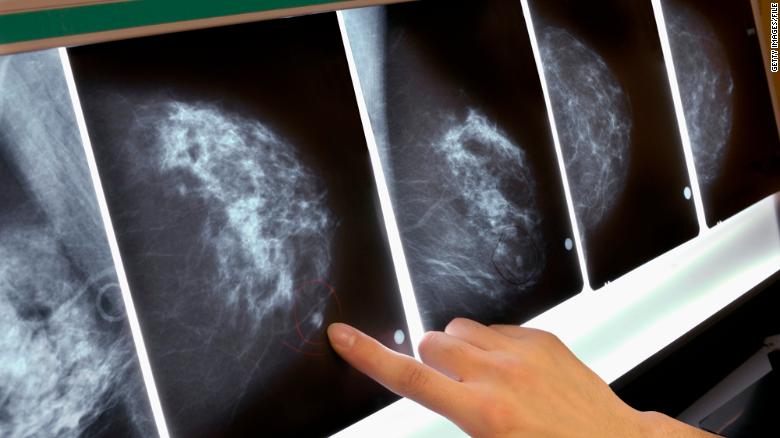 Breast Cancer Therapies Can Raise Heart Risks Doctors Warn Cnn 