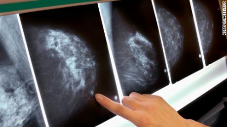 Body fat levels linked to breast cancer risk in post-menopausal women