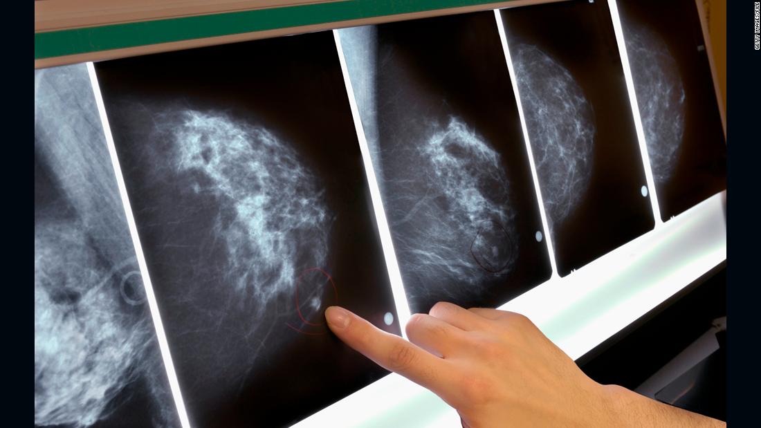 New Breast Cancer Screening Guidelines Cnn 