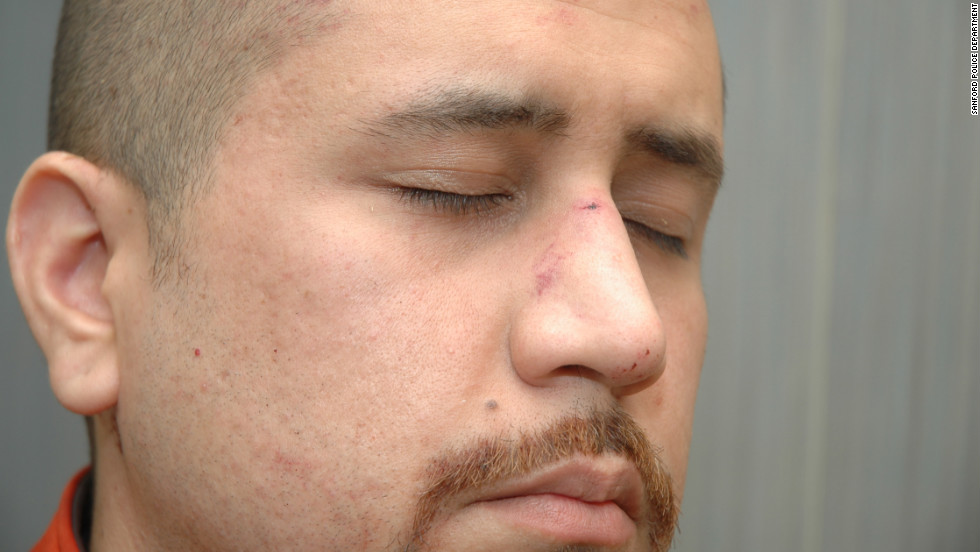 According to a fire department report, Zimmerman had &quot;abrasions to his forehead,&quot; &quot;bleeding/tenderness to his nose&quot; and a &quot;small laceration to the back of his head&quot; when he was treated at the scene.