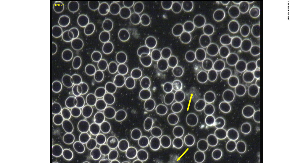 This image, taken after the subject went on a gluten-free diet, shows the blood cells are able to flow more freely -- allowing better transportation of oxygen around the body.