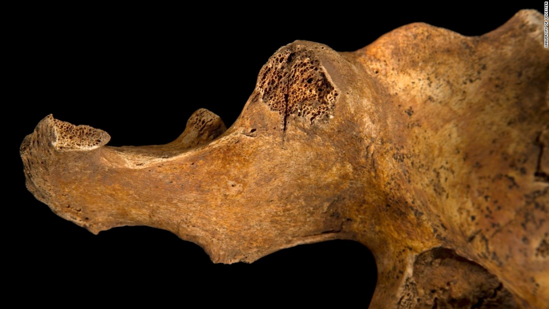 The image shows a blade wound to the pelvis, which has penetrated all the way through the bone.