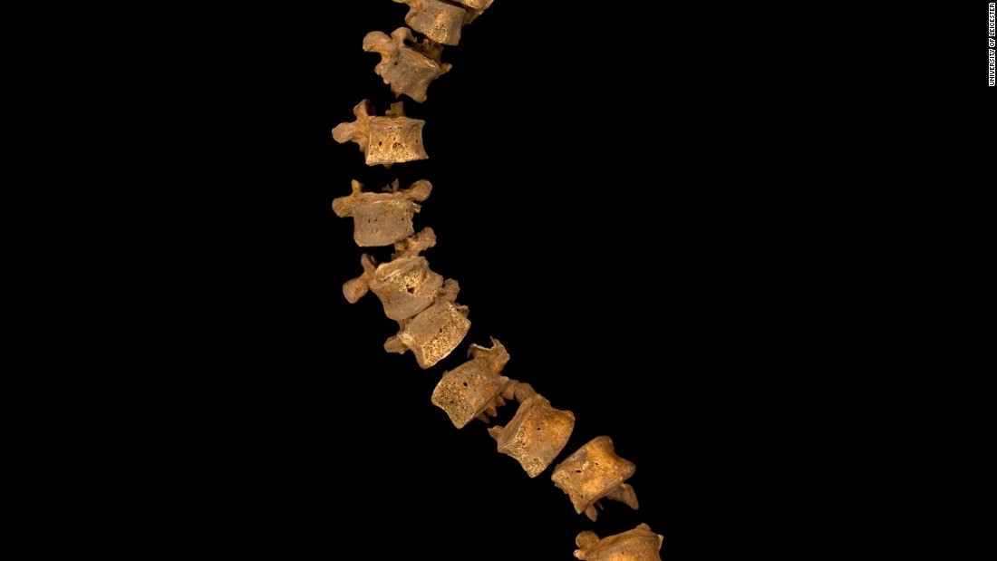 As the skeleton was being excavated, a notable curve in the spine could be seen. (The width of the curve is correct, but the gaps between vertebrae have been increased to prevent damage from them touching one another.)