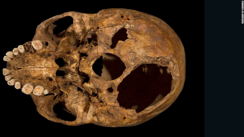 Scientists at the University of Leicester say their examination of the skeleton shows Richard met a violent death: They found evidence of 11 wounds -- nine to the head and two to the body -- that they believe were inflicted at or around the time of death. Here, the base of the skull shows one of the potentially fatal injuries. This shows clearly how a section of the skull had been sliced off.