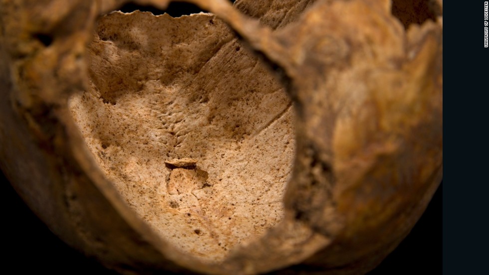 Two flaps of bone, related to the penetrating injury to the top of the head, can clearly be seen on the interior of the skull. 