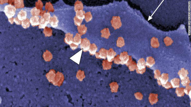 The SARS virus, a coronavirus like the common cold, is shown in pink in this electron micrograph image from the Centers for Disease Control.