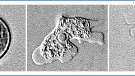 Six questions about the brain-eating amoeba, answered