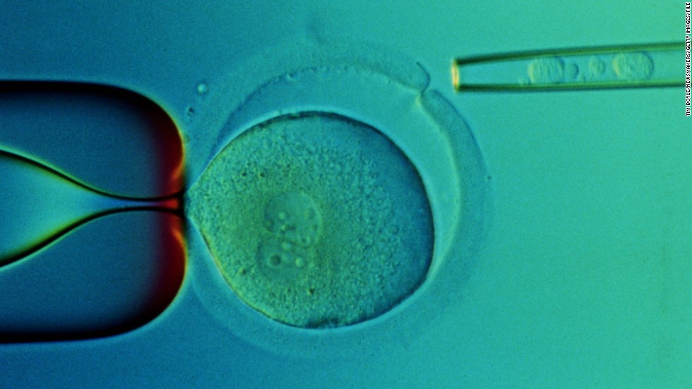 A closeup of a microscope slide taken in 2000 at the Reproductive Genetics Institute&#39;s Chicago laboratory shows transplanted stem cells taken from the umbilical cord blood of a baby named Adam Nash. Adam&#39;s sister Molly has a genetic disease called Fanconi anemia. Their parents wanted to have a child who could be a stem cell donor for Molly. Using in vitro fertilization, doctors created embryos and then tested them for the genetic disease. They chose one that did not have the disorder, which grew into baby Adam. Molly received a stem cell transplant from stem cells from Adam&#39;s umbilical cord. Both children are alive today.