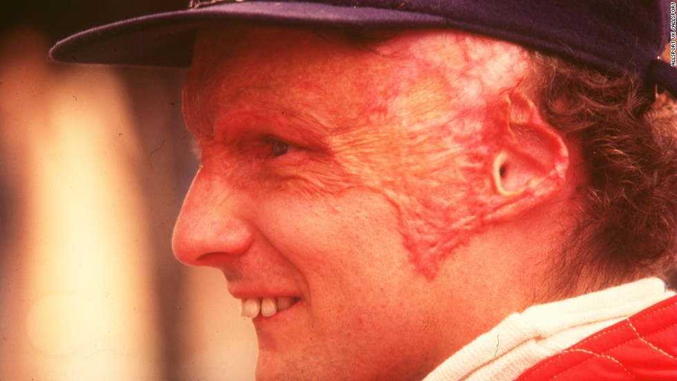 Lauda&#39;s crash at the Nurburgring at the beginning of August was the defining moment of the 1976 season. He suffered horrific burns and nearly lost his life but somehow found the courage to return to the track at Monza just 43 days later. The Ferrari driver conquered his fears and finished fourth to the amazement of everyone and the delight of the Tifosi.  