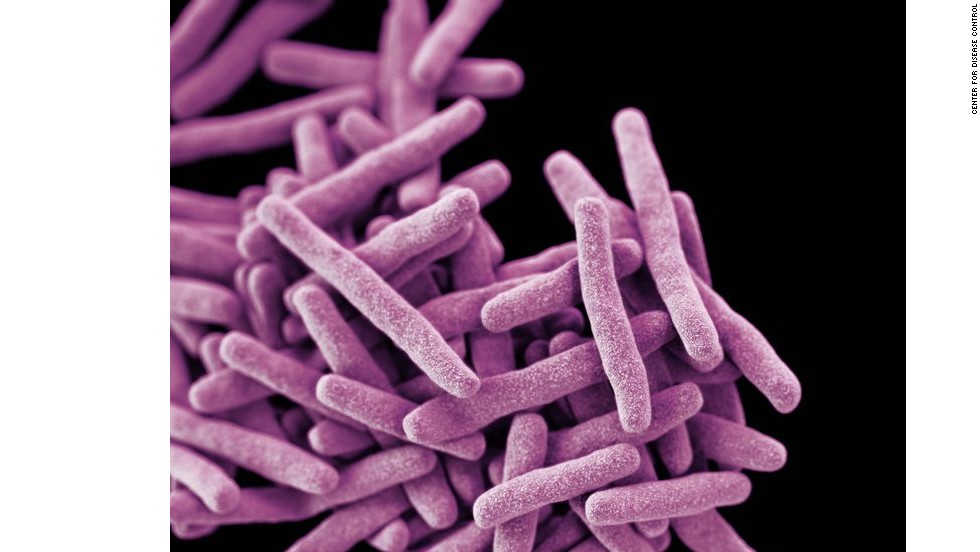 Drug-resistant tuberculosis